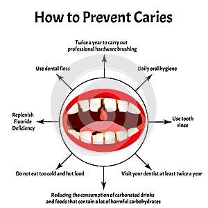 How to prevent the appearance of caries. Bad breath. Halitosis. The structure of the teeth and oral cavity with caries