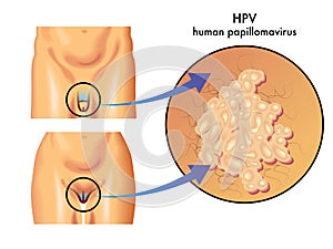 HPV (human papillomavirus) photo