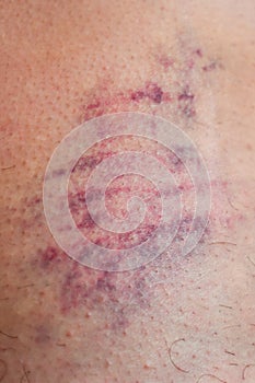 Huge bruise on the body. Close-up - wounded leg with bruise and abrasion. Injured skin. Household injuries, harm to health