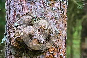 Huge excrescence on pine tree trunk. Sick diseased forest tree. color