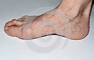 Hullux valgus foot disease, curvature of the toes.