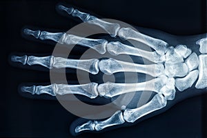 Human adult right hand bones x-ray image. Medical and anatomy radiography or imagery