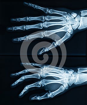 Human adult right hand skeleton x-ray image. Medical and anatomy imagery