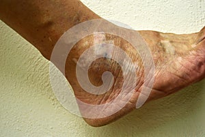 Human ankle, with condition vitiligo.