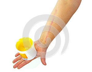 Human arm with postoperative scar of cardiac surgery