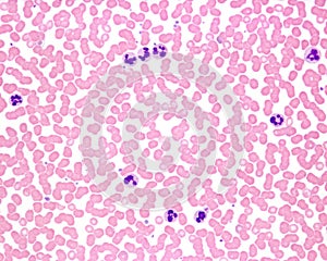 Human blood smear. Leukocytosis photo