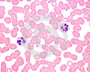 Human blood smear. Neutrophil hypersegmentation