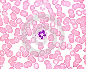 Human blood smear. Neutrophil hypersegmentation photo