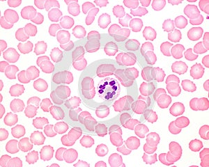 Human blood smear. Neutrophil hypersegmentation photo