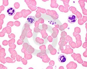 Human blood smear. Neutrophil hypersegmentation photo