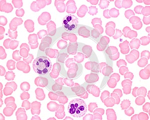 Human blood smear. Neutrophil hypersegmentation photo