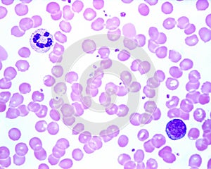 Human blood smear. Neutrophil and lymphocyte