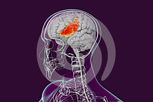 Human brain in the body with highlighted inferior frontal gyrus photo