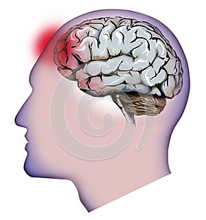 Human brain, cerebellum and headaches. Headache