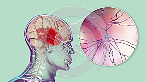 Human brain with highlighted temporal lobe and close-up view of neurons photo