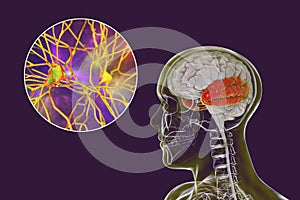Human brain with highlighted temporal lobe and close-up view of neurons photo