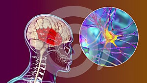 Human brain with highlighted temporal lobe and close-up view of neurons photo