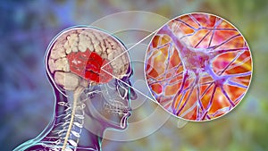 Human brain with highlighted temporal lobe and close-up view of neurons photo