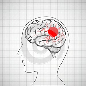 Human brain inside the head. Migraine disease. photo