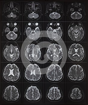 Human brain MRI on light box