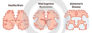 Human brain MRI scan. Healthy and Alzheimer's disease brain