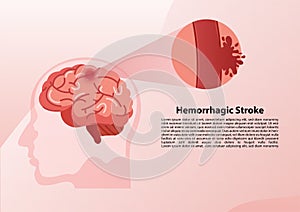 Human brain stroke illustration