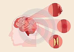 Human brain stroke illustration