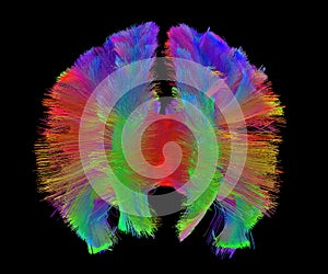 Human brain white matter corpus callosum photo