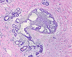 Human breast. Epithelial hyperplasia