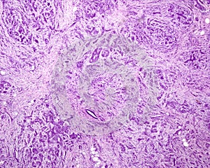 Human breast malignant carcinoma