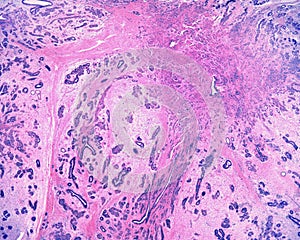 Human breast. Sclerosing adenosis photo