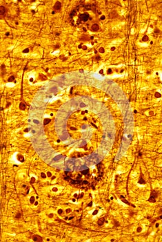 Human cerebral cortex. Senile plaques