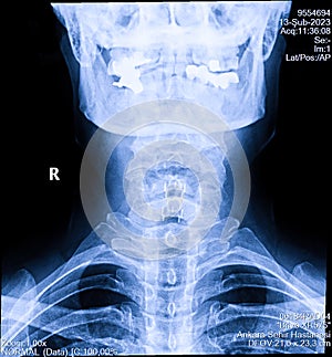 Human cervical spine x-ray, neck radiography