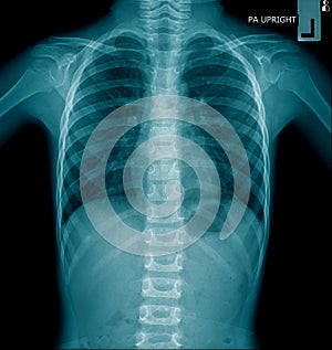 Human chest x-ray