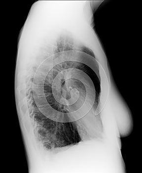 Human Chest X-ray image, orthogonal projection for a medical diagnosis