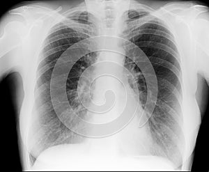 Human Chest X-ray image, orthogonal projection for a medical diagnosis