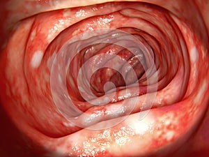 Human colon affected by ulcerative colitis