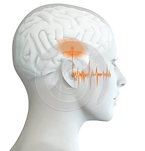 Human ear of a woman with soundwave, tinnitus, medically 3D illustration