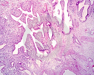 Human endocervical polyp