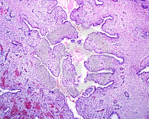 Human endocervical polyp
