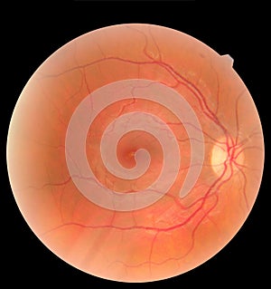 Human eye anatomy taking images with Mydriatic Retinal cameras. Examination of the eye, diabetic retinopathy, ARMD