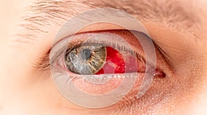 Human Eye with Bloodshot Detail Close Up