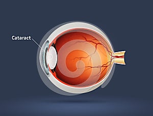 Human eye - cataract photo