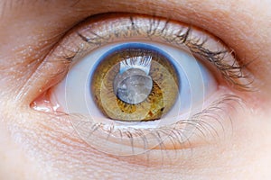 Human eye with clouded lens, white pupil, cataract macro