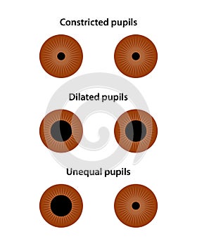 Human eye. Constricted, dilated, and unequal pupils.