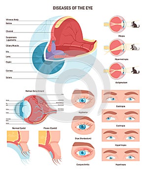 Human eye diseases set. Human vision organ, eyesight and eyelid problem.