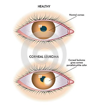 Corneal Leukoma medical illustration photo