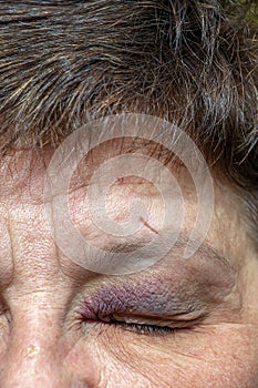 A human eye with a large black-violet bruise. Swelling due to bruise photo