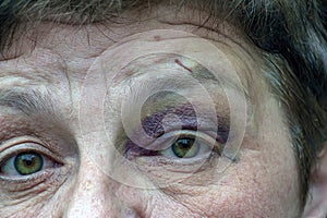 A human eye with a large black-violet bruise. Swelling due to bruise photo