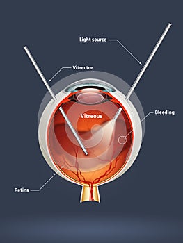 Uomo occhio vitrectomia 